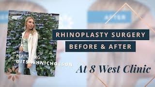 Rhinoplasty Transformations | Before & After Pictures - 8 West Clinic in Vancouver BC