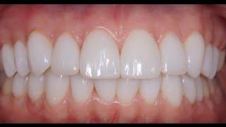 Виниры без обточки зубов. Люминиры. Non-prep porcelain veneers. Carillas Dentales. 牙齿镶