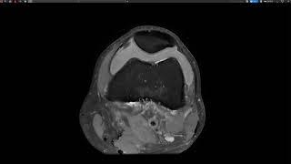 Knee injury  LCL Bursa