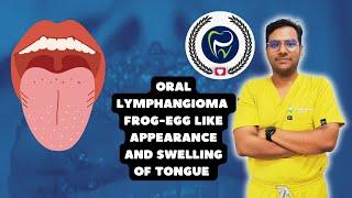 Dr Rudra Mohan | Oral Lymphangioma of the Tongue - Frog Egg like Appearance & Swelling of theTongue