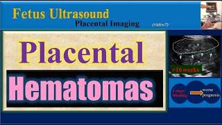 Fetus Ultrasound, Placental Hematomas