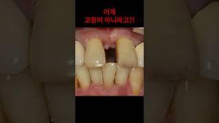 벌어진 앞니를 치료하는 또 하나의 방법#shorts