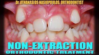 Non-Extraction Orthodontic Treatment (Case K.I.) | Athanasios Tom Nasiopoulos, Orthodontist