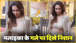 Malaika Arora GETS TROLLED For Her Stretch Marks In Crop Top | Watch Video