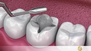 Dentistry: Removal of caries