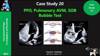 Case Study 20: PFO, Pulmonary AVM, SOB & Bubble Test