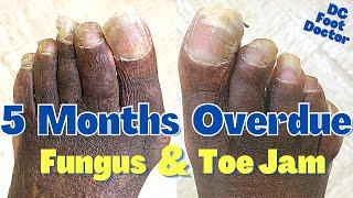 5 Months Overdue: Toenail Trimming, Fungus, and Toe Jam