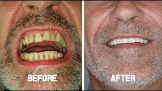 Dental Implants & Zirconium Crowns - Mr.Thomas from Manchester