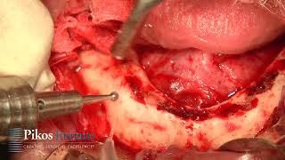 Easy Mandibular Anterior-Posterior Spread, Safely Avoiding Mental Nerve when Placing Dental Implants