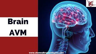 Brain Arteriovenous Malformation(AVM) Symptoms, Causes And it's Treatment