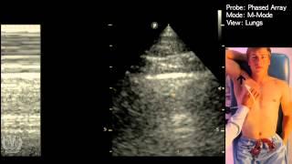 M Mode for Lung Ultrasound - Lung Sliding