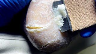 There Are Cracks On The Thick White Callus, And You Can Cut It Off【Pedicure Master Lin Jun】