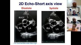 PArt 1 Aortic & Pulmonic Stenosis by Dr Sameer Shrivastava 19 May 2023