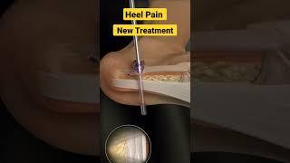 New Treatment Method for Heel Pain