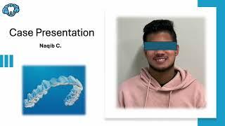 Orthodontic Case Presentation - Invisalign Aligners