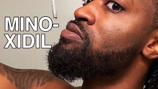 Why I Stopped Using Minoxidil | Does Minoxidil Actually Work?