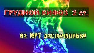 КИФОЗ ГРУДНОГО ОТДЕЛА позвоночника 2 степени на РАСШИФРОВКЕ МРТ грудного отдела