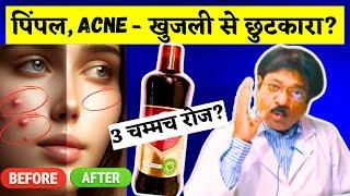 पिंपल्स और एक्ने का BEST इलाज- Khadirarishta | Dabur Khadiraristhta Syrup ke Fayde | डाबर खदिरारिष्ट