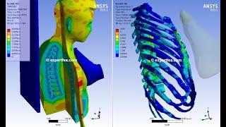 1st in the World!!! ANSYS WB Explicit Dynamics - Biomechanics simulation of leg kick in the chest