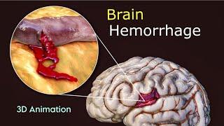 What Triggers Brain Hemorrhage? : 3D Animation | Scopic Vision