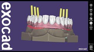 exocad Video Tutorial (advanced): Virtual Gingiva and Digital Waxup Design