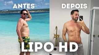 RESULTADO LIPO HD MASCULINA - Antes e depois da cirurgia de alta definição com Argoplasma e Morpheus