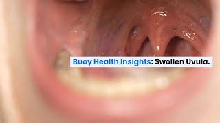 Swollen Uvula: Common Causes and When to Seek Medical Care  | BuoyHealth.com