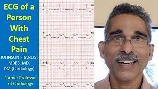 Discussion of ECG of a Person With Chest Pain