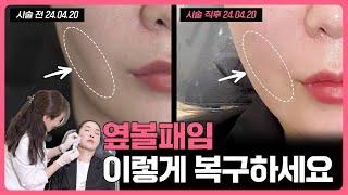 옆볼패임 쉽고 빠르게 해결하기 I 그늘진 얼굴형 개선 I