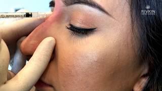 Rhinoplasty (non-surgical) by Dr. Rivkin