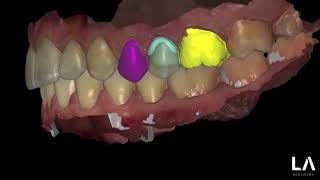 EGGSHELL TECHNIQUE Provisional Crowns in EXOCAD