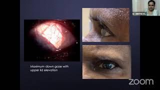 AIOS ARC Update Series on Challenging Moments in Glaucoma Surgeries   Dr  NEETHU MOHAN