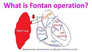 What is Fontan operation?