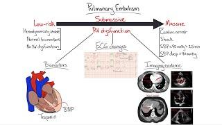 Chalk Talk: Pulmonary Embolism