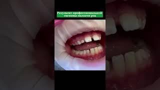 Профессиональная гигиена полости рта #стоматология #лечениезубов #dentistry