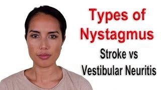 Types of Nystagmus Due to Stroke vs Vestibular Neuritis Causing Persistent Dizziness or Vertigo