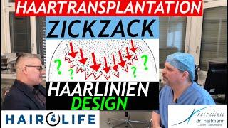 Haartransplantation künstlicher Haaransatz️Warum eine Zickzack Haarlinie nicht immer natürlich ist!