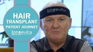 Hair Transplant Story | Longevita