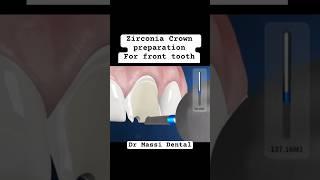 Zirconia Crown preparation