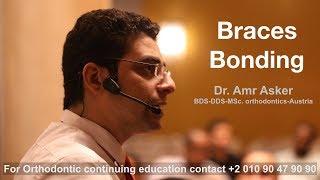 Braces bonding in orthodontics by dr. Amr Asker Egypt