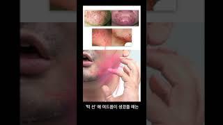 '턱 선'에 여드름이 생기면 위험한 이유!  | 피부과전문의 김홍석