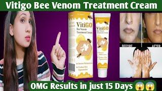 Vitigo Bee Venom Treatment Cream Honest Review|Vitigo Bee Venom Treatment Cream|2025