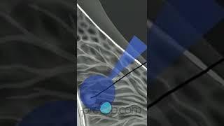 Breast Biopsy Wire Localization: Step-by-Step Guide   #PreOp #Shorts #BreastBiopsy Pt. 3