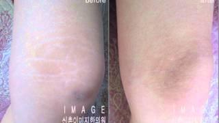 튼살침, 흉터치료, 팽창선조, 후산한의원, 튼살치료전문, 튼살병원, 찾는 요령, 질병, disease, 상병, illness, 탈모, 미용치료, 성형수술흉터침, OT침, 화상흉터침