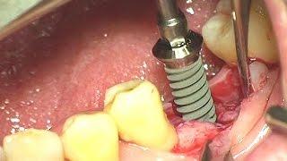 Simple installation using Dentium SimpleLine II system