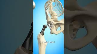 Total Hip Replacement  (Explained)