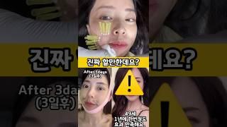 실리프팅 시술 전후 대공개! 1개월 후 충격적인 변화! #beforeandafter