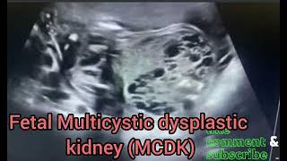 Fetal multicystic dysplastic kidneys. (MCDK).