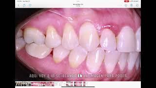 Recesión gingival