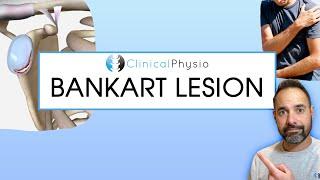 Bankart lesion | Expert Physio Reviews Shoulder Dislocations, Mechanism Of Injury and Treatment